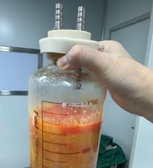 泽州水动力吸脂手术要做多久？